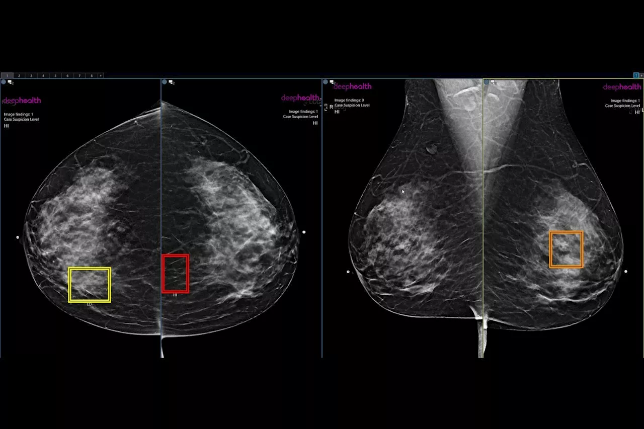 AI Is Detecting More Breast Cancer Cases, Study Suggests