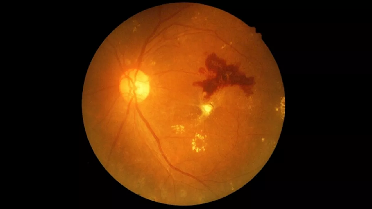 Empagliflozin May Slow Diabetic Retinopathy