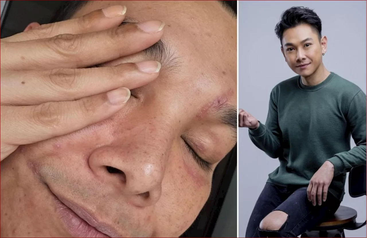 Singaporean actor Ryan Lian shares photos of scarred face after slashing attack