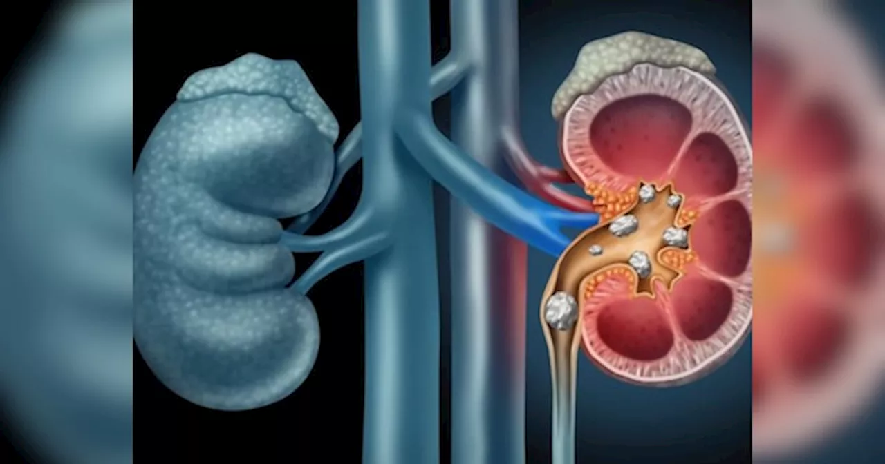इन गलतियों से बार-बार होता है किडनी में स्टोन; कारण और बचाव के उपाय