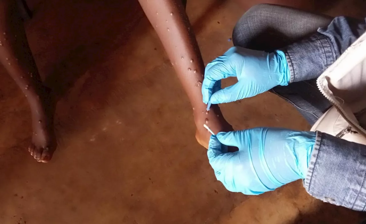 Africa: 'We Are Still Losing People To Mpox'