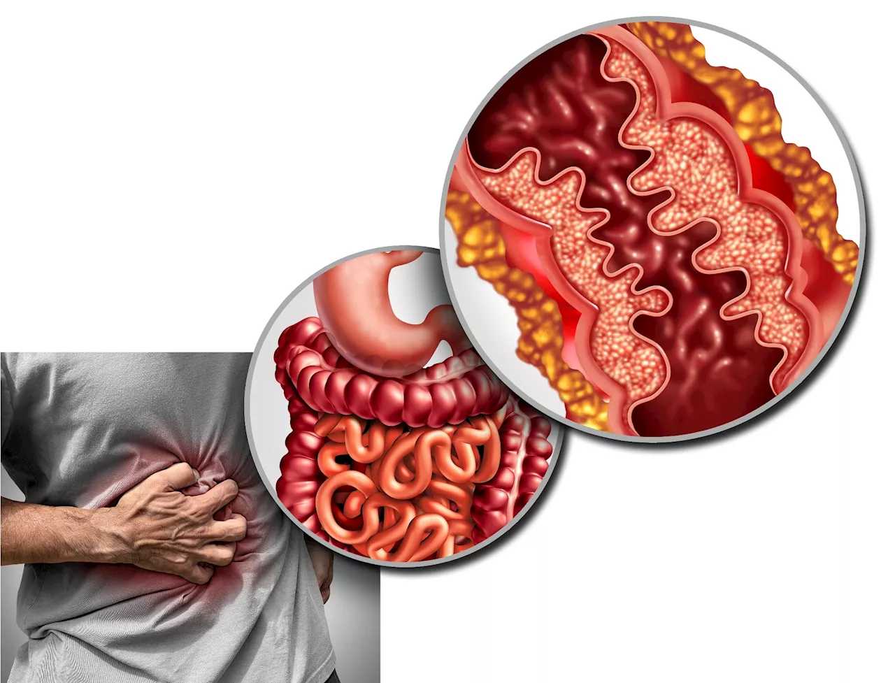 Filgotinib offers new promise for managing Crohn’s disease