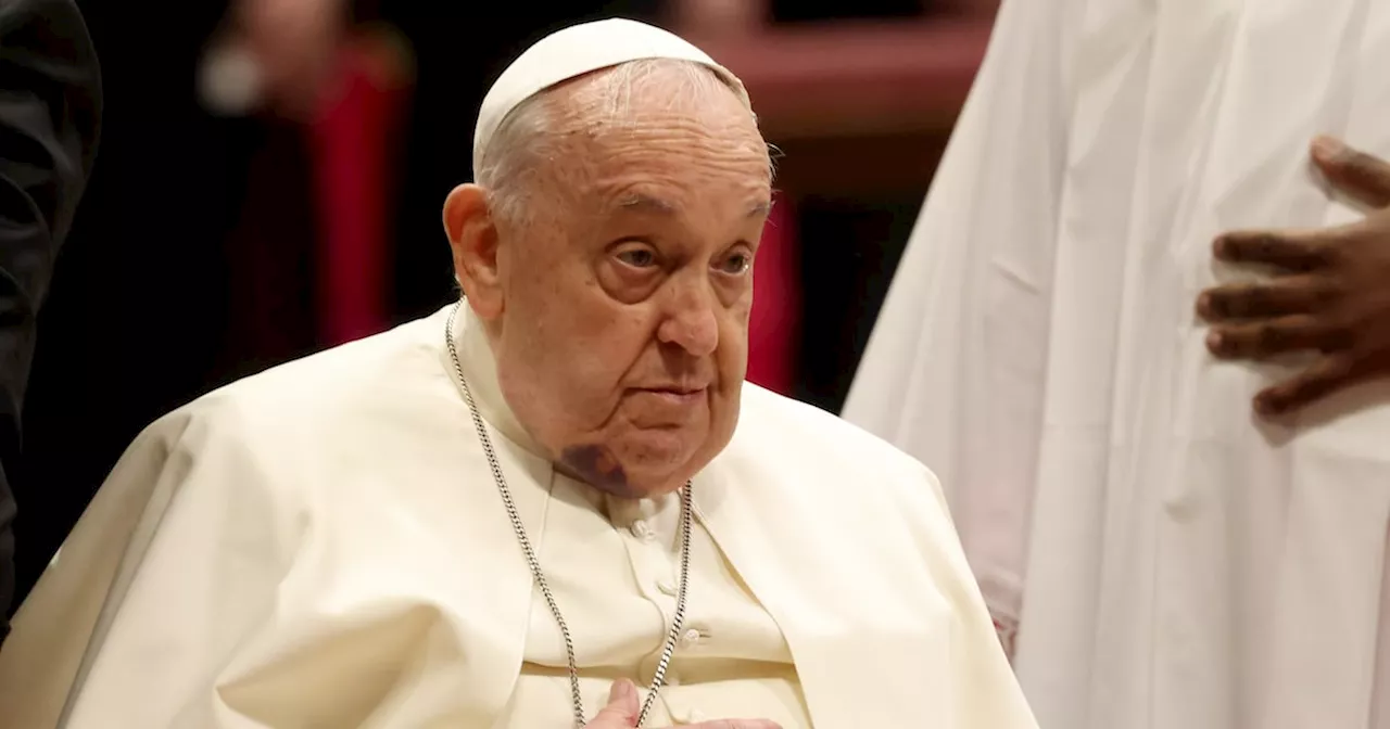 Pope Francis Sparks Health Concerns With Mystery Bruise