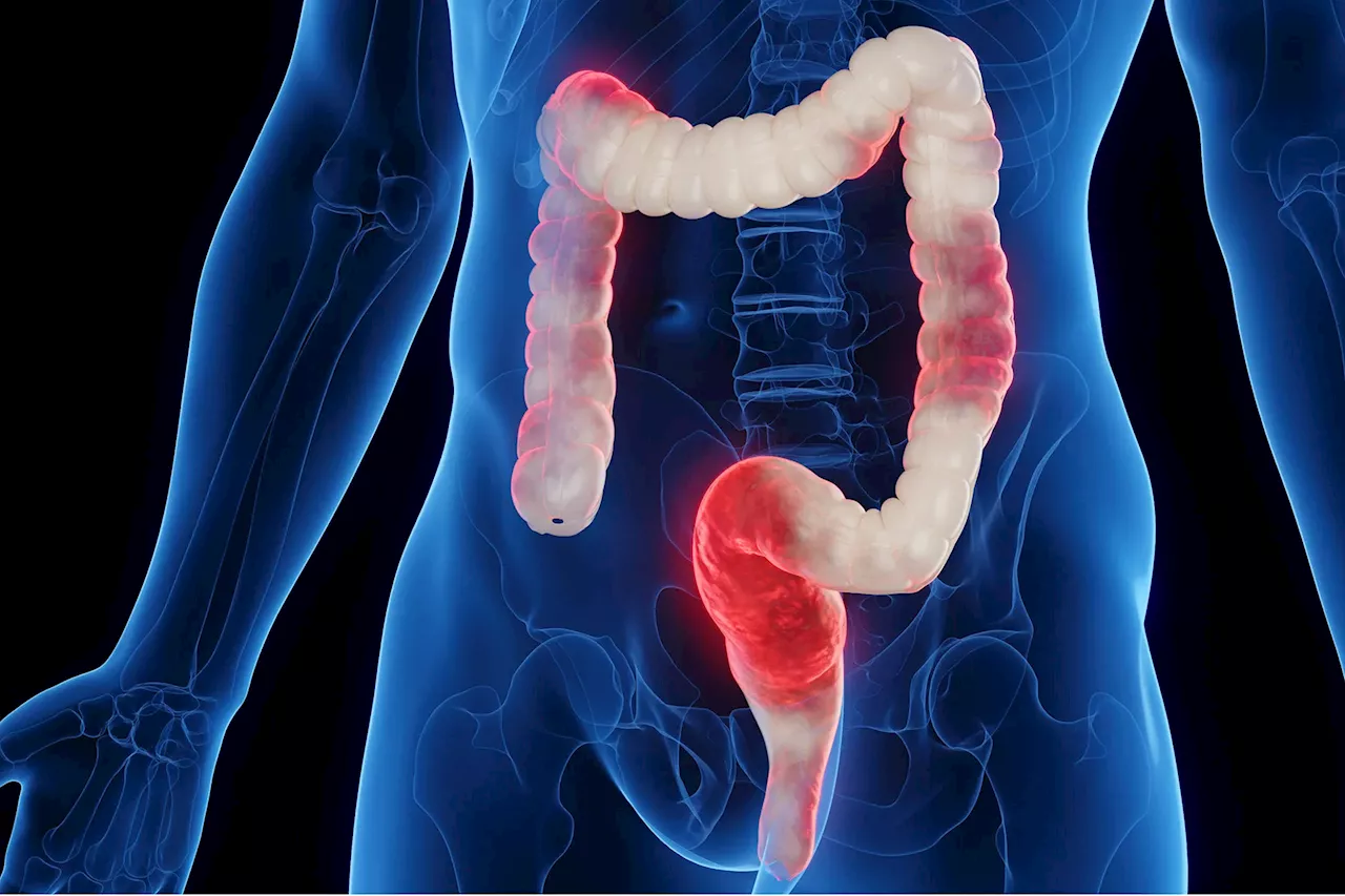 Ulcerative Colitis: New Medications, New Hope for Remission