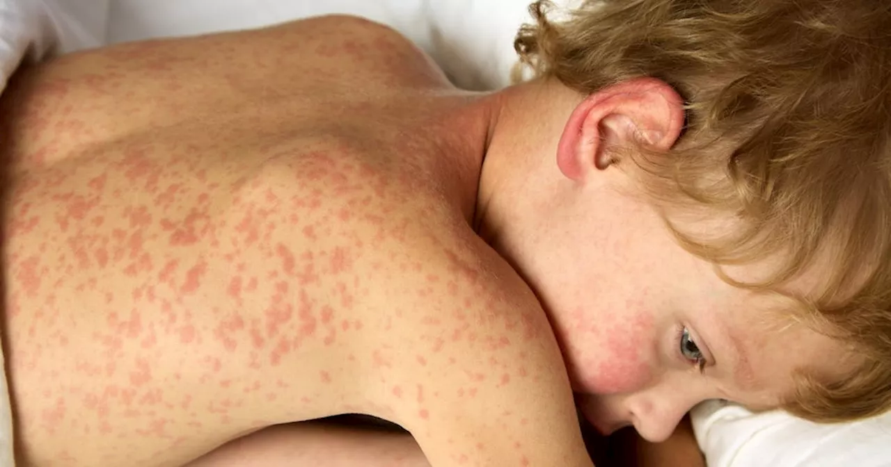 Netmums Investigates: why are fewer parents vaccinating their child against measles?