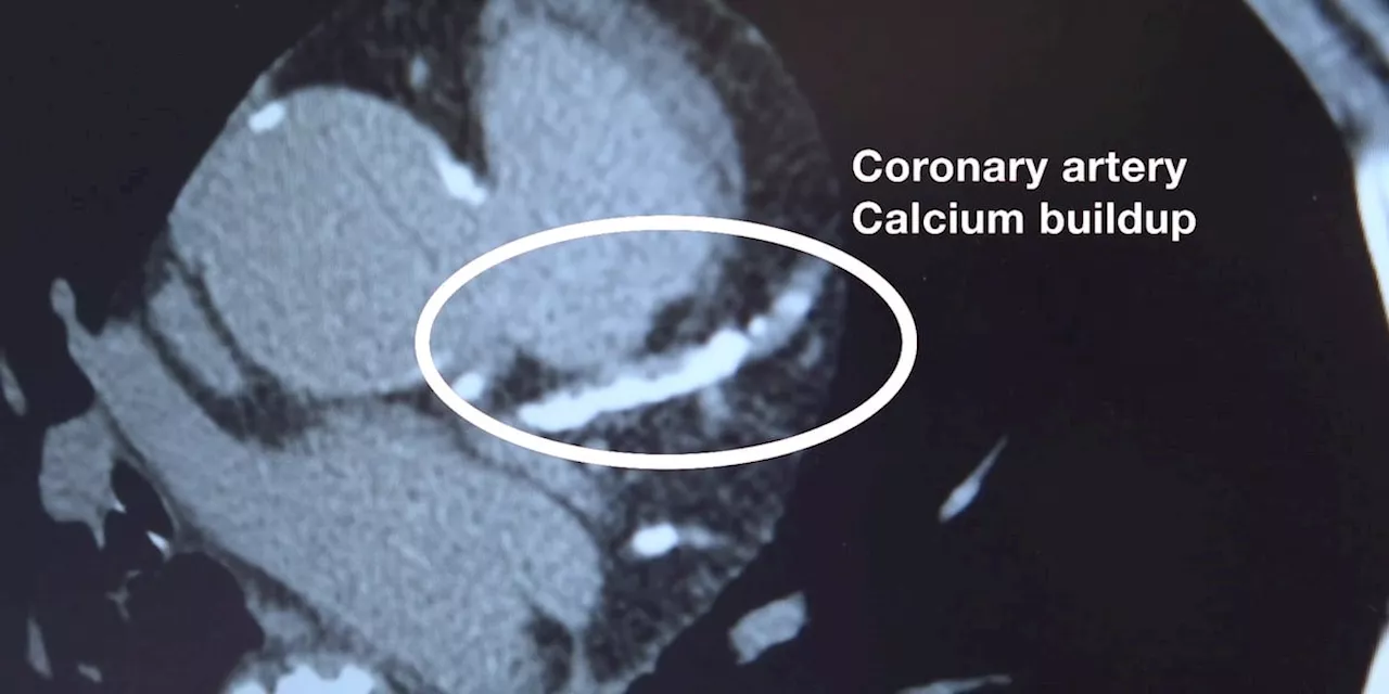 Coronary Calcium Scans provide a look at heart health