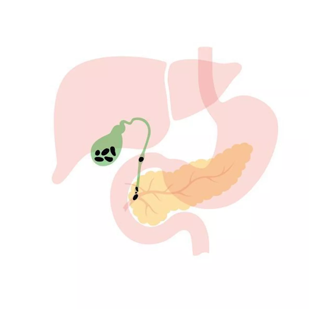 결석 없는 담낭염, 천공 위험 5배 높아…조기 수술해야