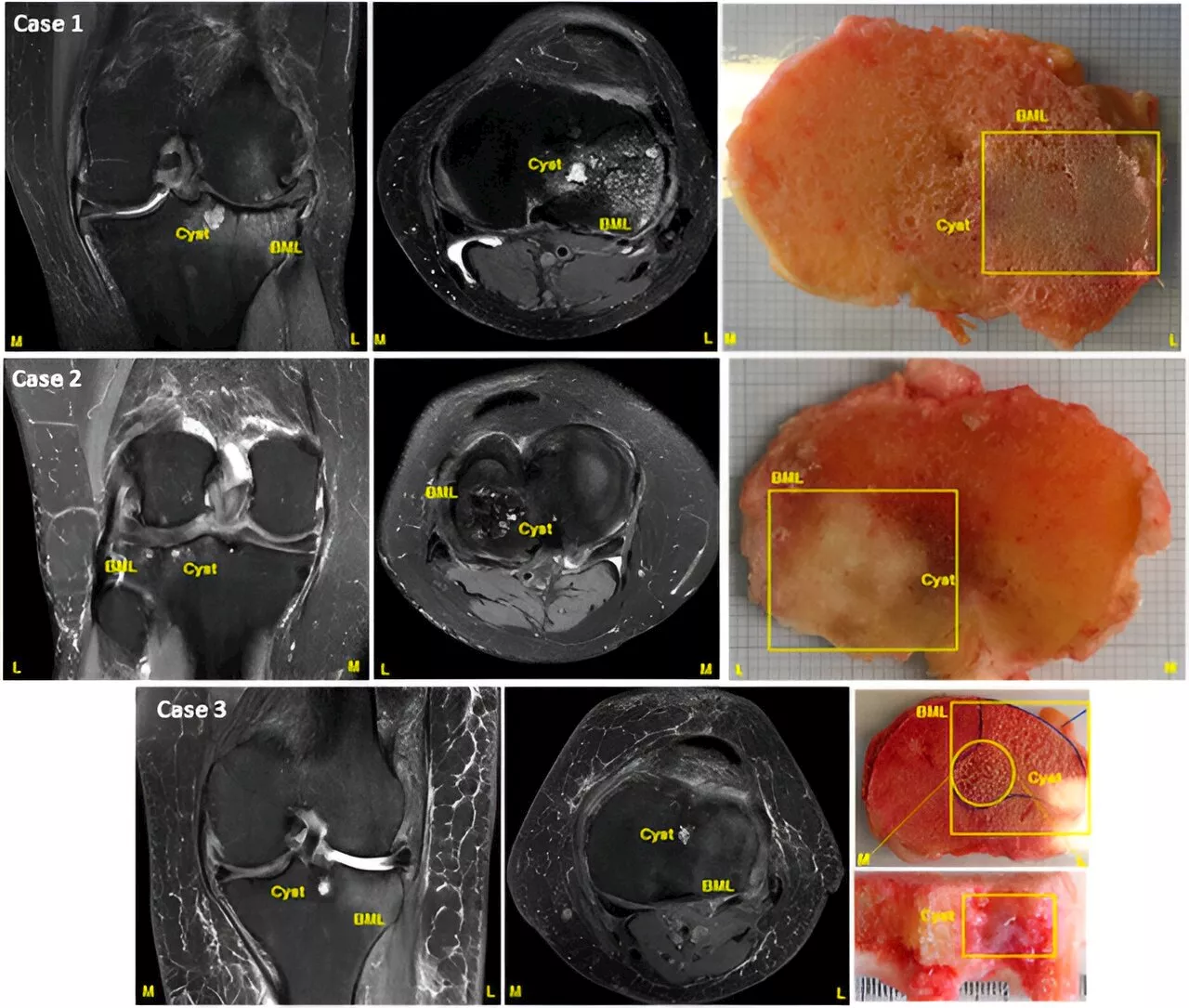 New bone tool could offer speedy screening for new treatments targeting pain in osteoarthritis