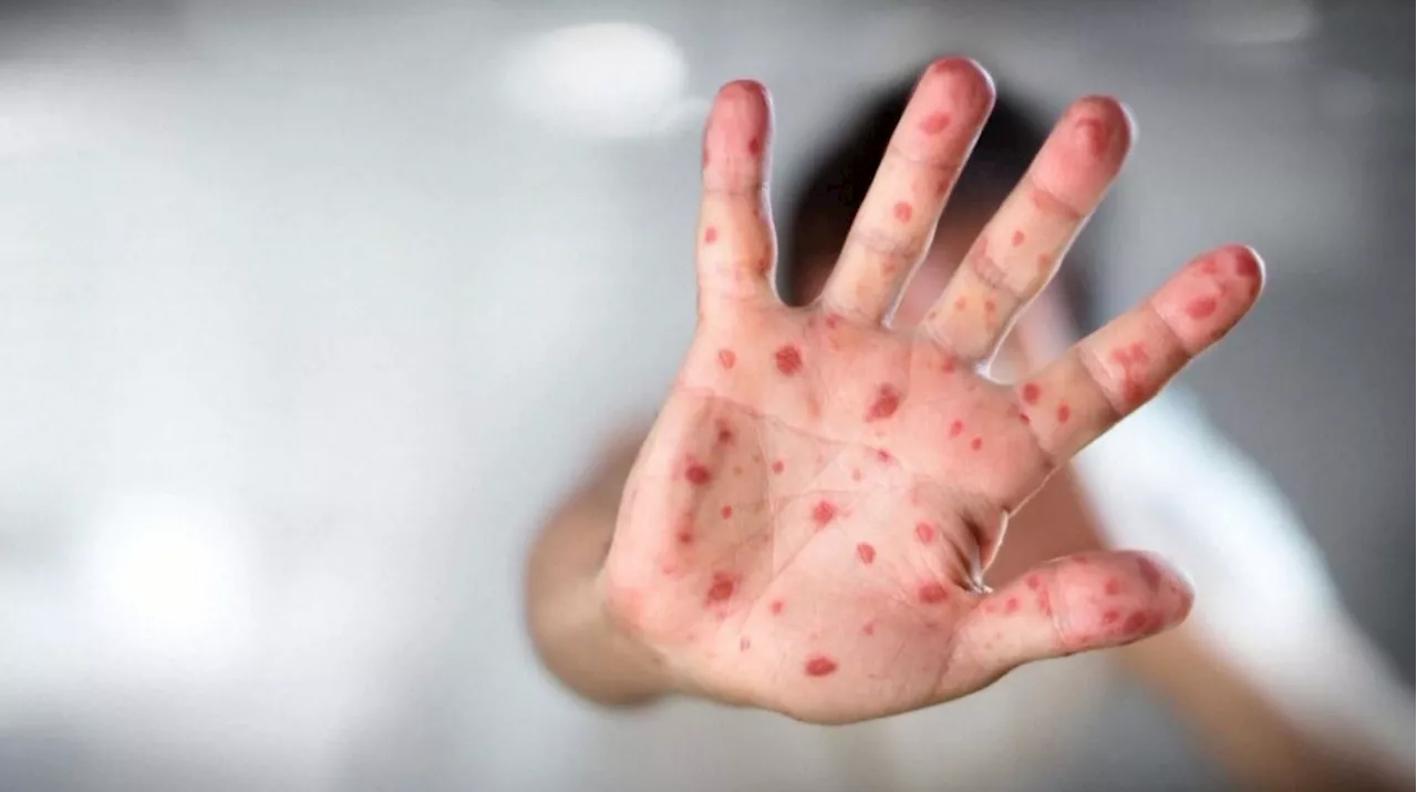 No measles confirmed in Ottawa: Public health monitoring re-emergence