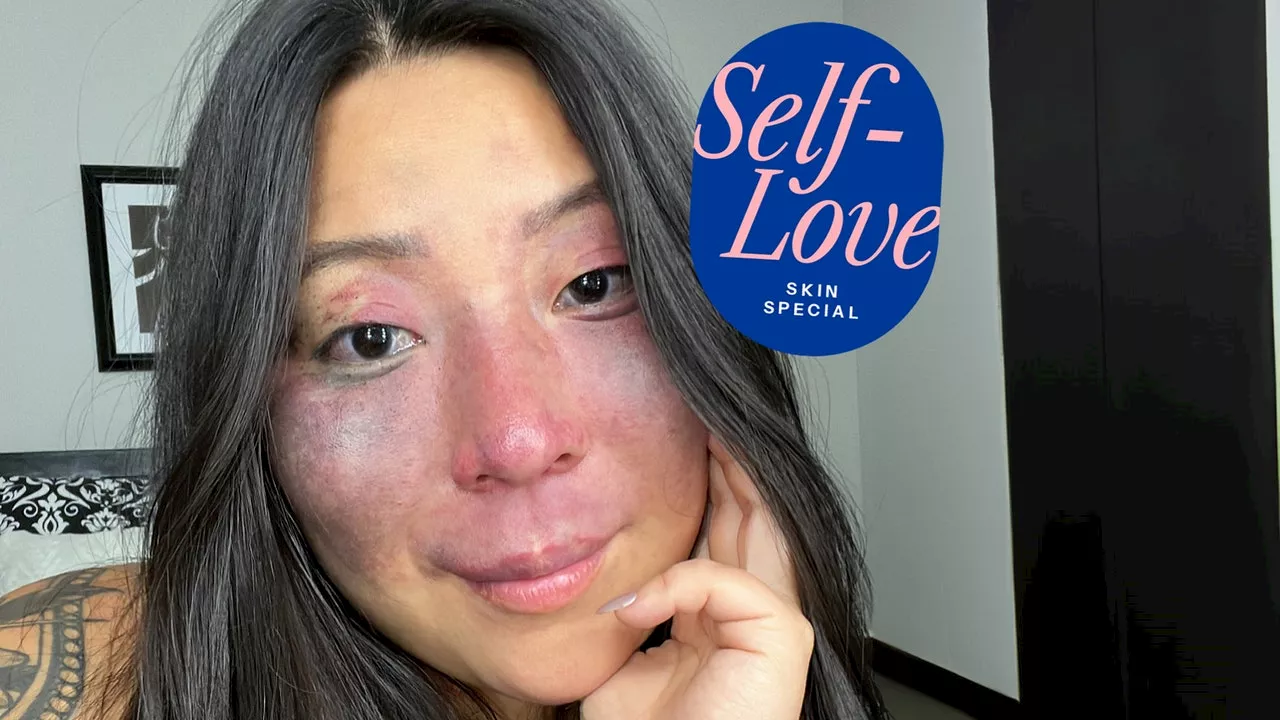 GLAMOUR's Self-Love Special: Celebrating Unique Beauty and Misunderstood Skin Conditions