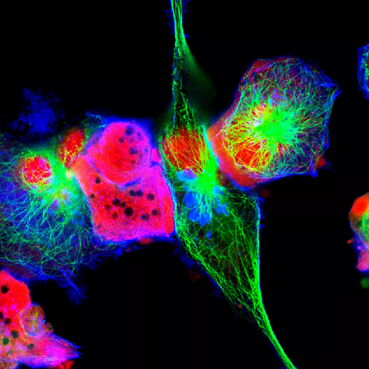 Il neuroblastoma nel mirino della medicina di precisione