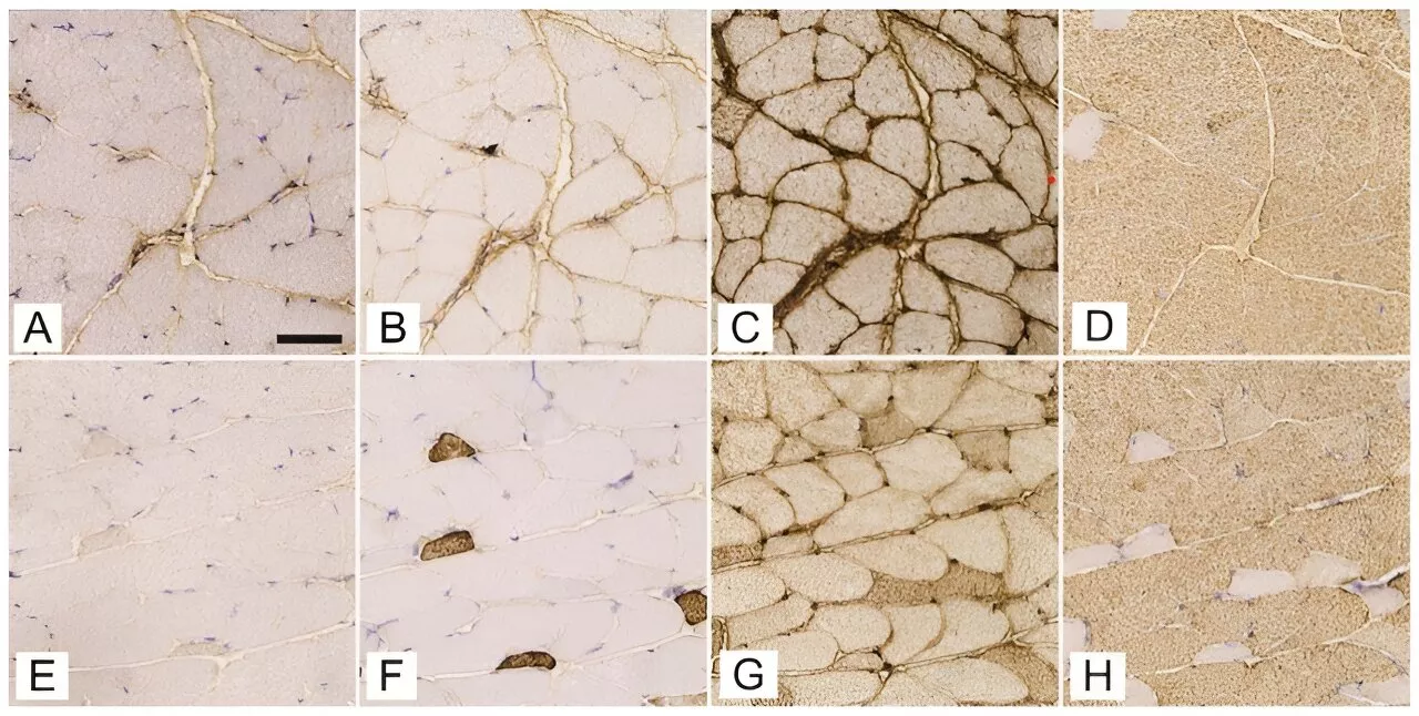 How does type 1 diabetes alter muscle structure and blood supply?