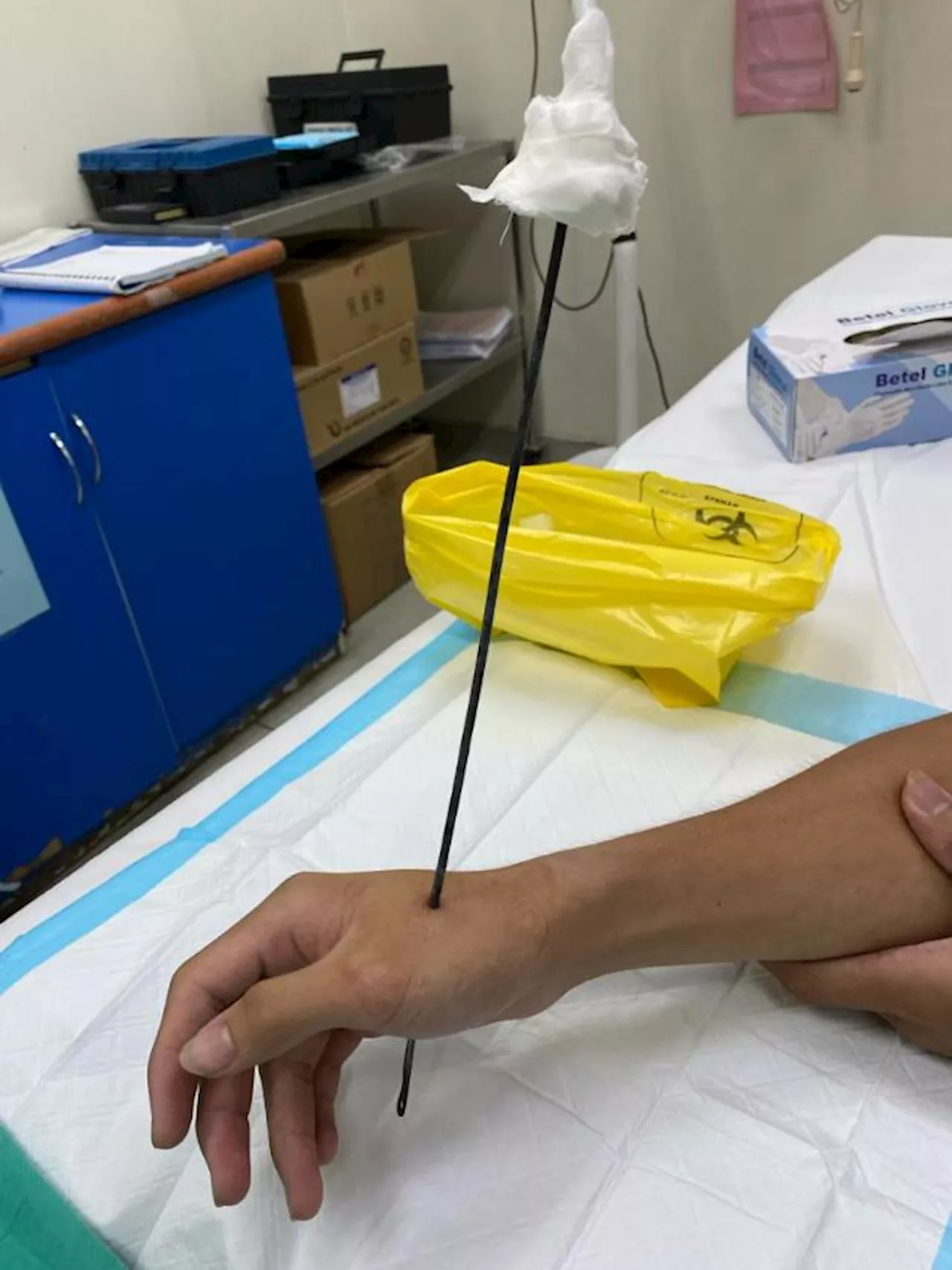 Arrow pierces man's hand during spearfishing in Ranau