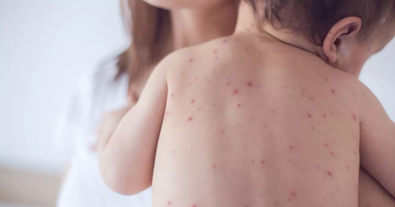 HSE warns thousands of possible measles exposure