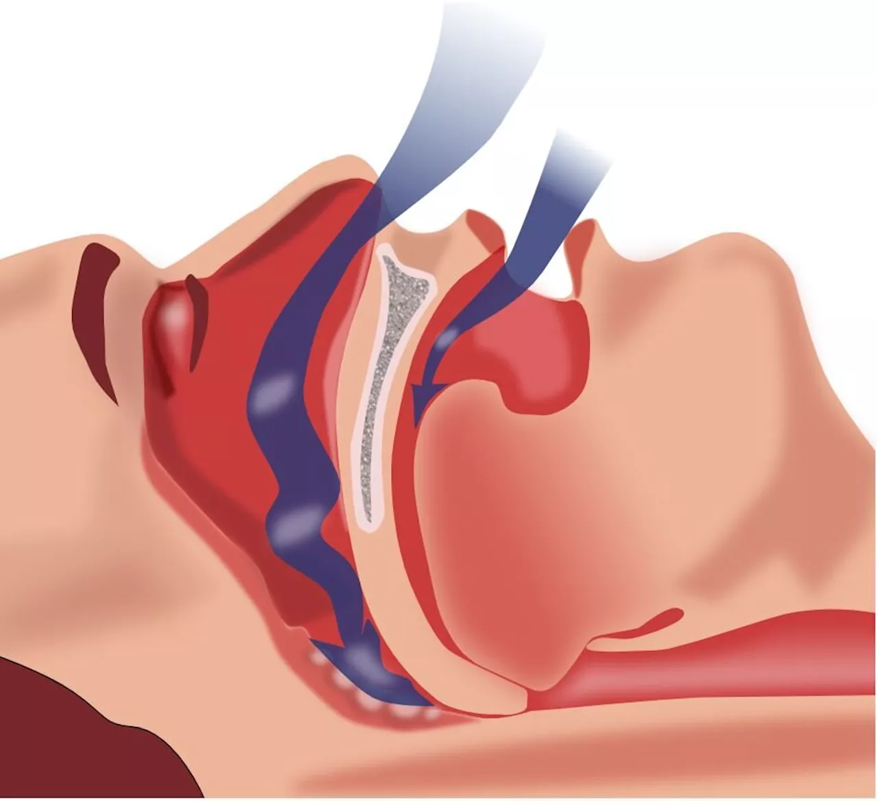 Data show significant prevalence of sleep apnea among cardio-oncology patients