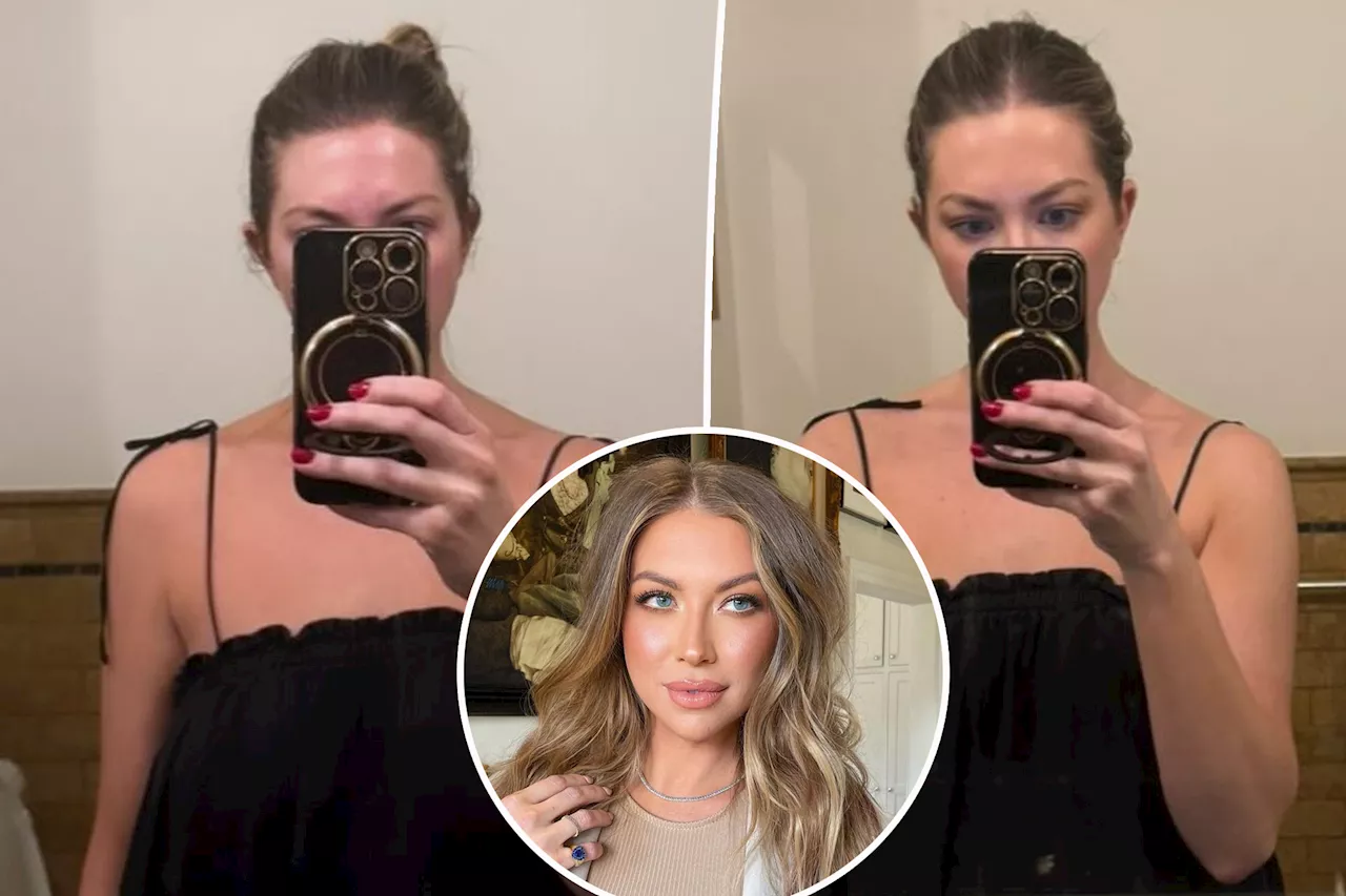 Stassi Schroeder shows before-and-after results of 'Barbietox' injections: 'You're welcome'