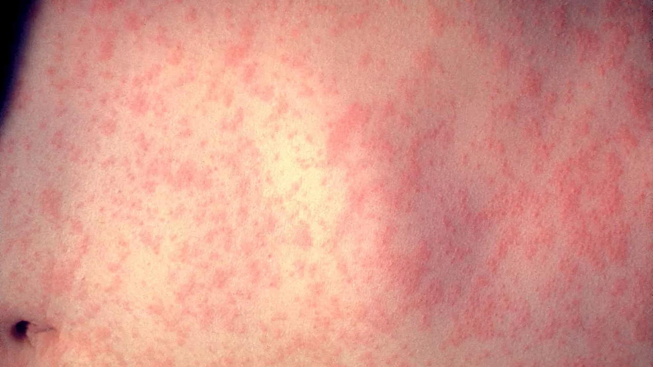 Another migrant child at Pilsen shelter diagnosed with measles