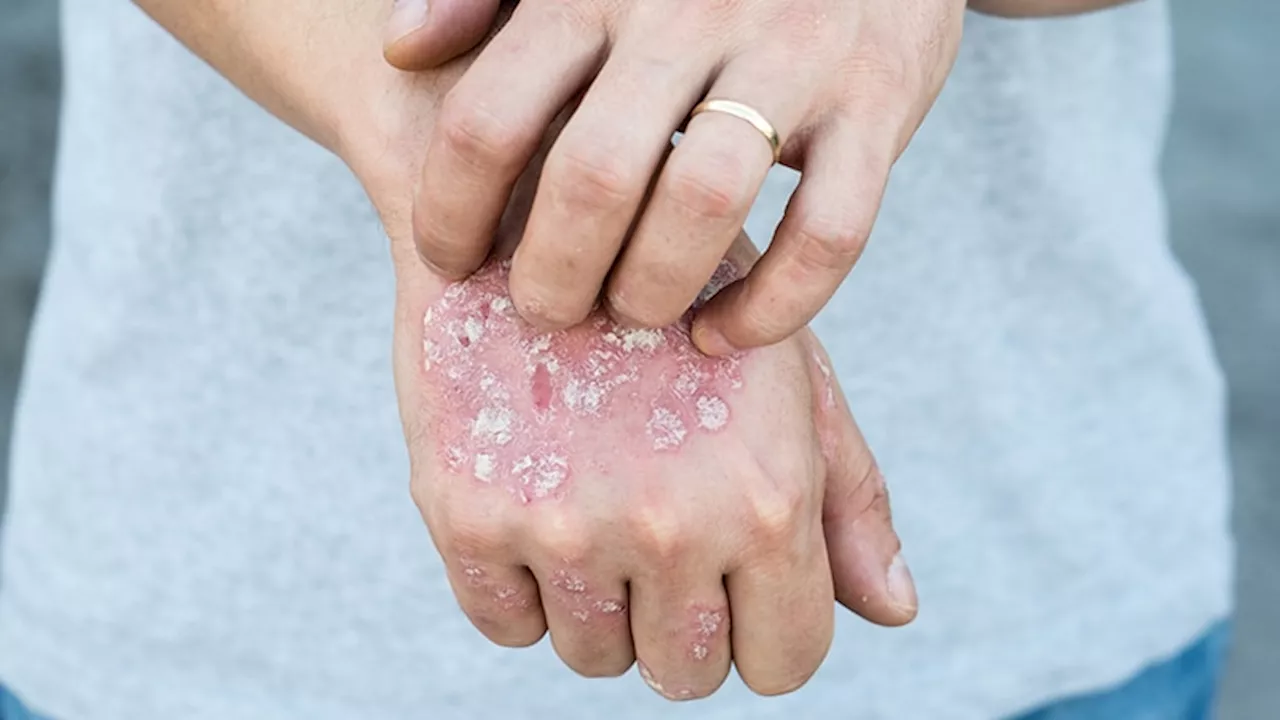 Anti-IL-17, Anti-IL-23 Therapies Show Sustained Psoriasis Control