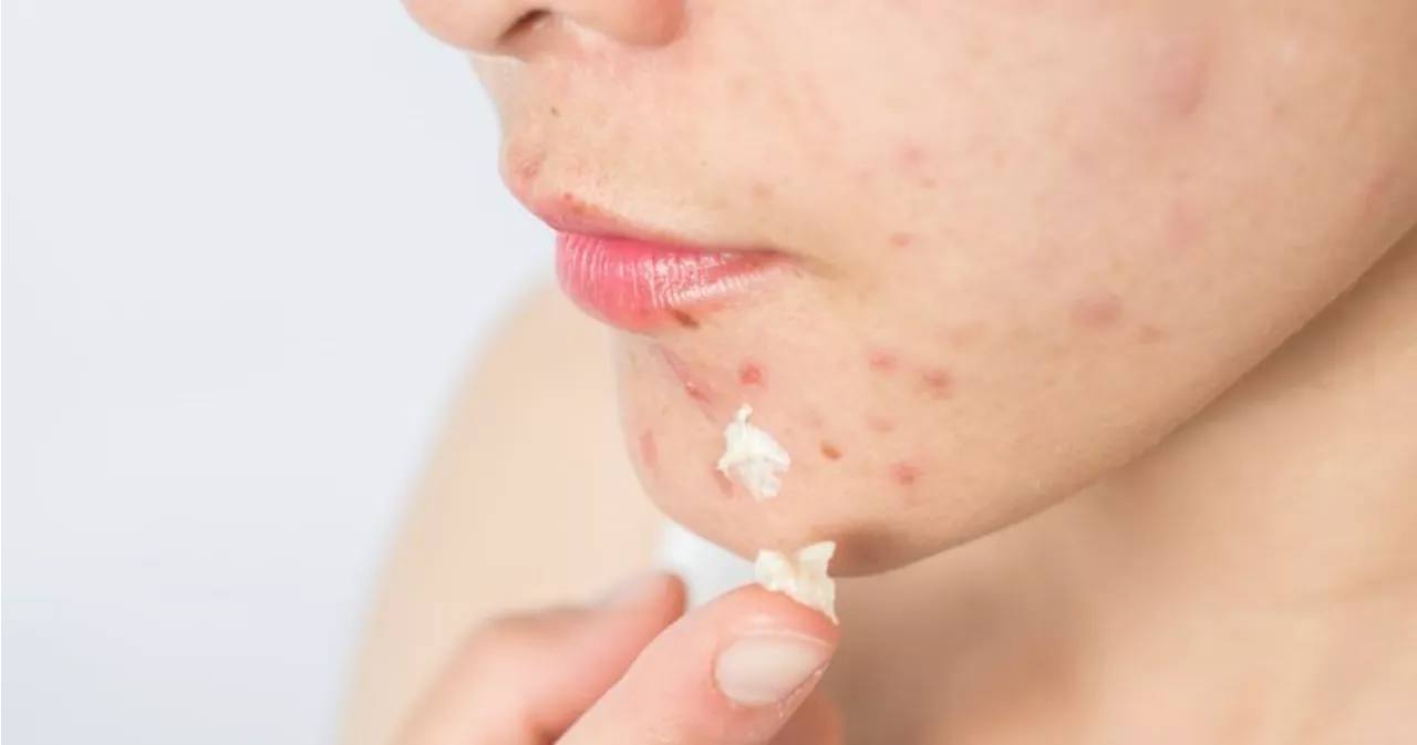 Health Canada ‘reviewing’ U.S. lab’s findings of benzene in acne products