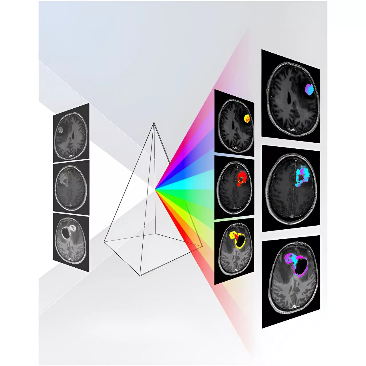 New AI-based, non-invasive diagnostic tool enables accurate brain tumor diagnosis, surpassing current methods