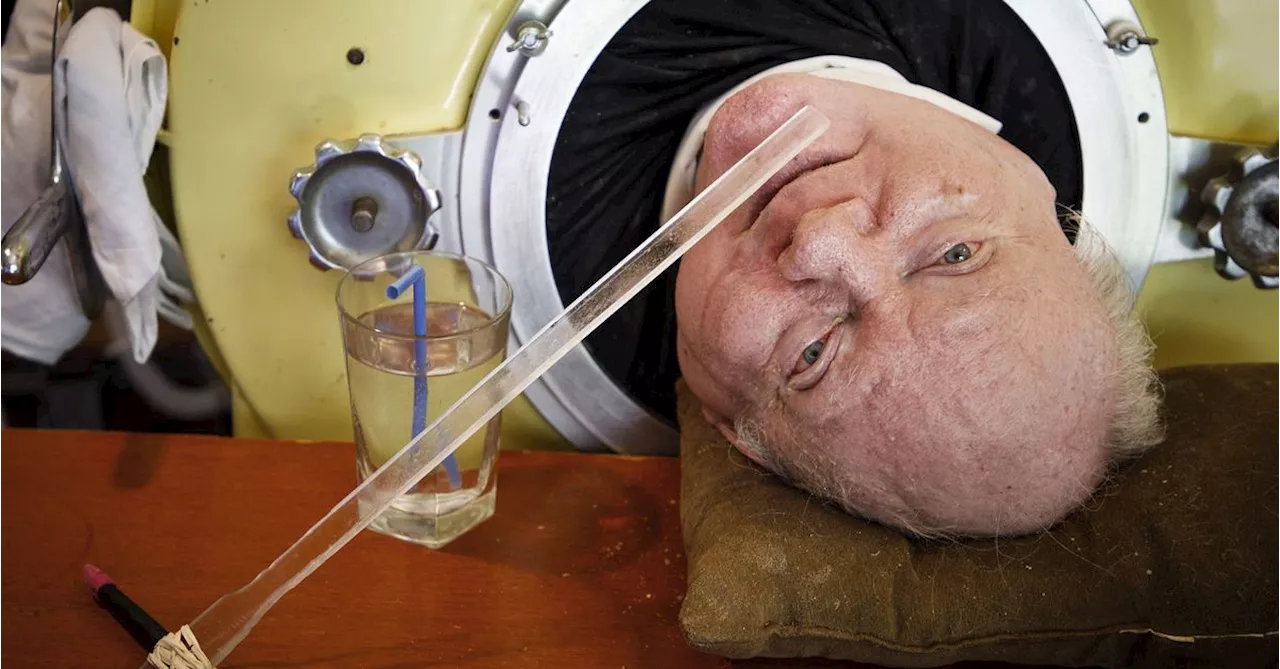 Man Who Spent Most of His Life in Iron Lung Dies at 78