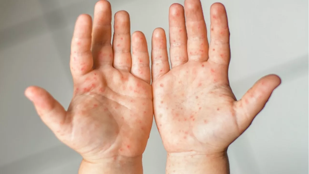 Ontario measles: Number of cases surpasses total for 2023