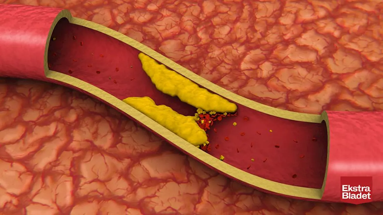 Lægens fem råd: Få bugt med forhøjet kolesterol