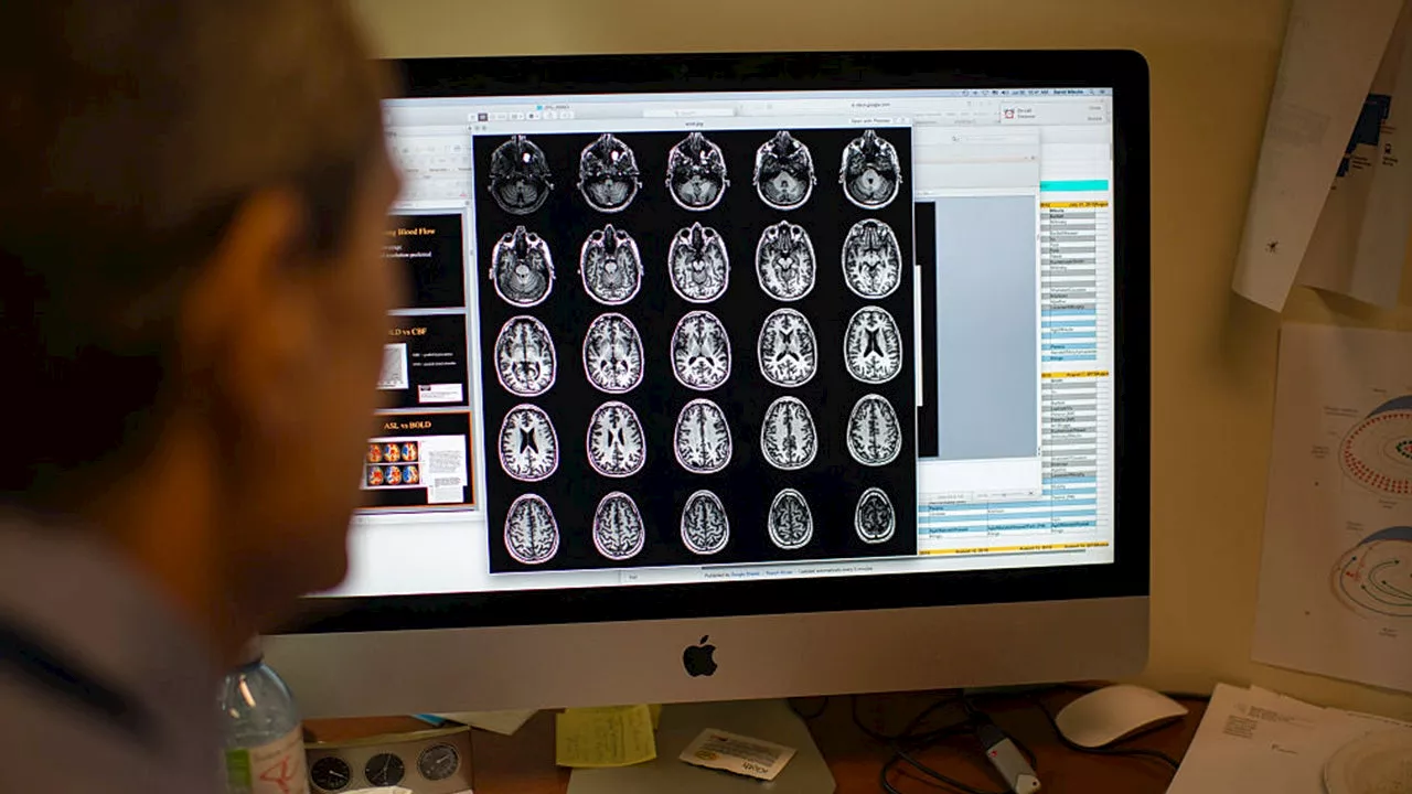Man Discovers Tapeworm Larvae in Brain After Eating Undercooked Bacon