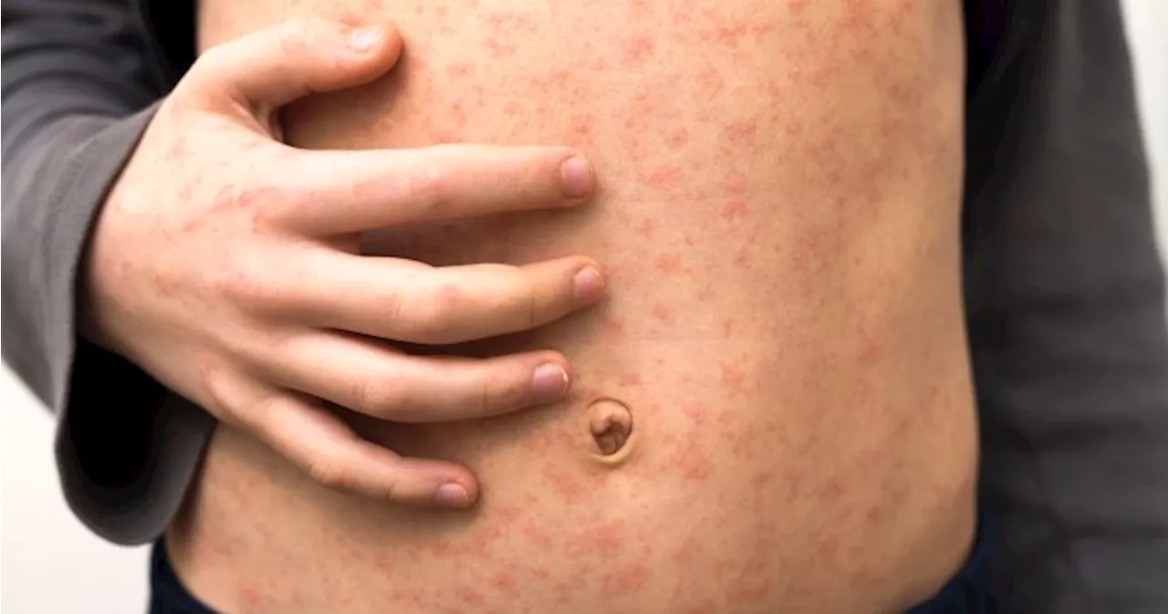 1st case of measles confirmed in Simcoe Muskoka region, latest in Ontario