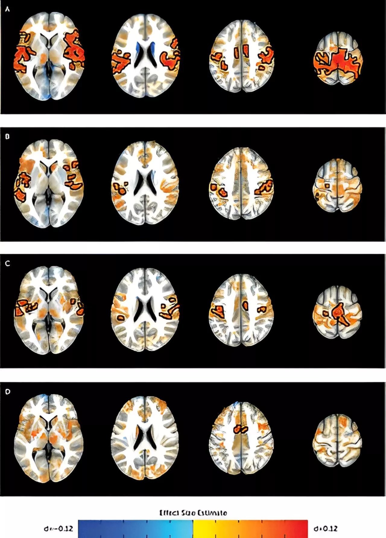 Researchers identify brain connections associated with ADHD in youth