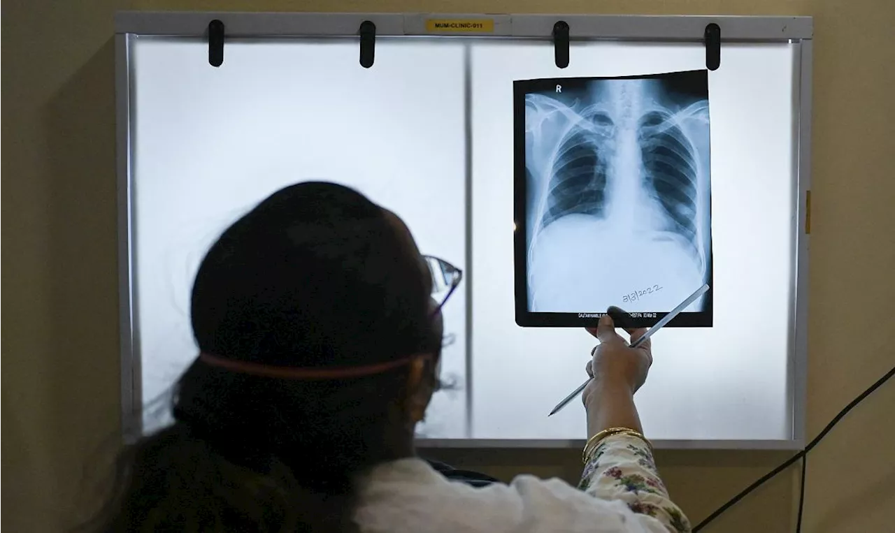 Tuberculosis in PH ‘alarming’ as cases hit 612,000 in 2023 —DOH