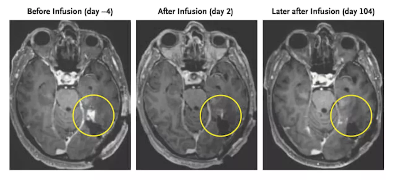 A new strategy to attack aggressive brain cancer shrank tumors in two early tests