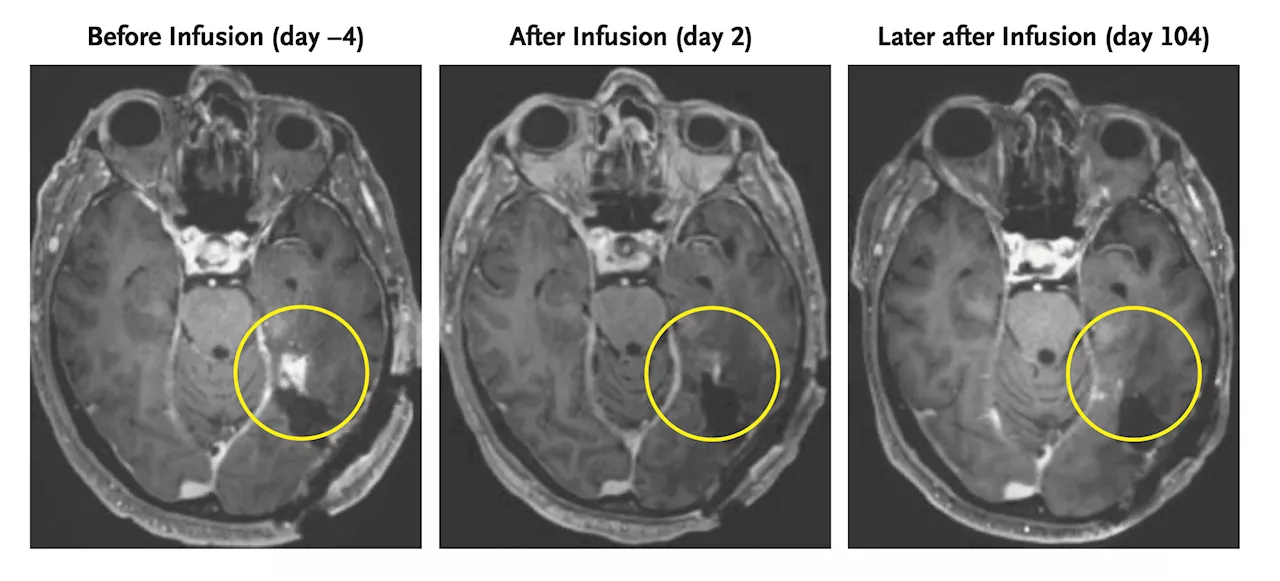 New Strategy Shows Promise in Shrinking Aggressive Brain Tumors