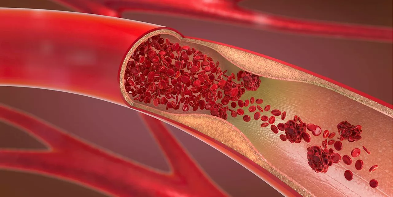 What Does a Blood Clot Feel Like? Experts Explain the Signs and Symptoms