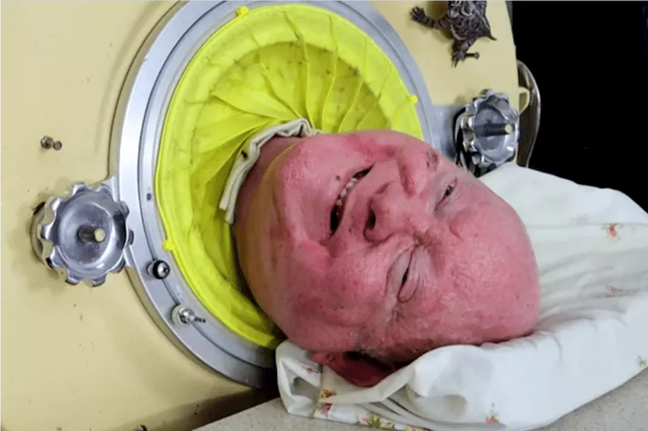 American Man Who Lived in Iron Lung for 70 Years Dies at 78