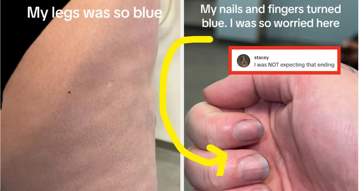 Viral Story: Woman Turns Blue From Shein Leggings