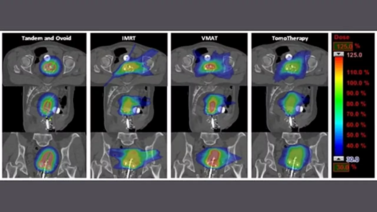 Customized Radiation of Uterus in Cervical Cancer May Not Compromise Outcomes