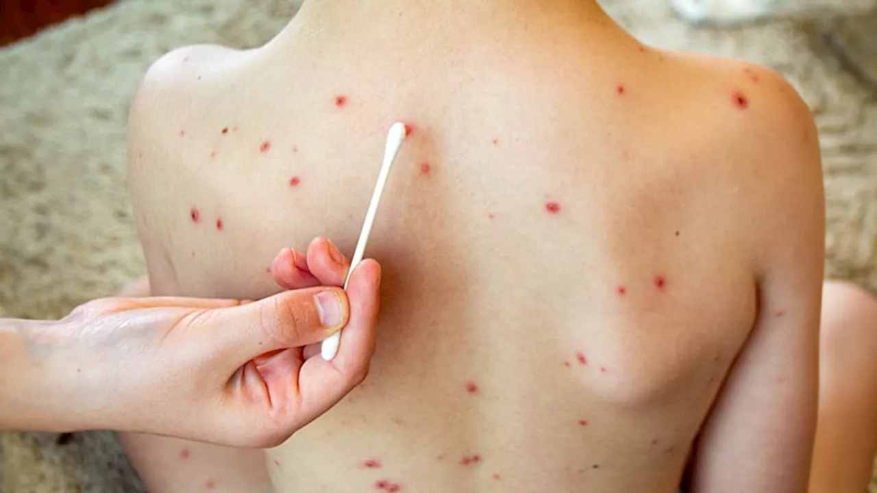 Measles Cases on the Rise in the United States