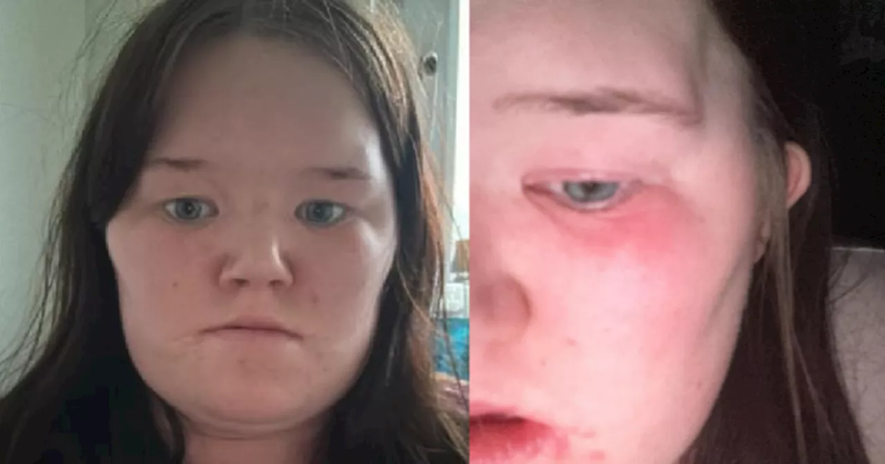 Scots mum left with eye infection after £80 botched lash extensions burned face