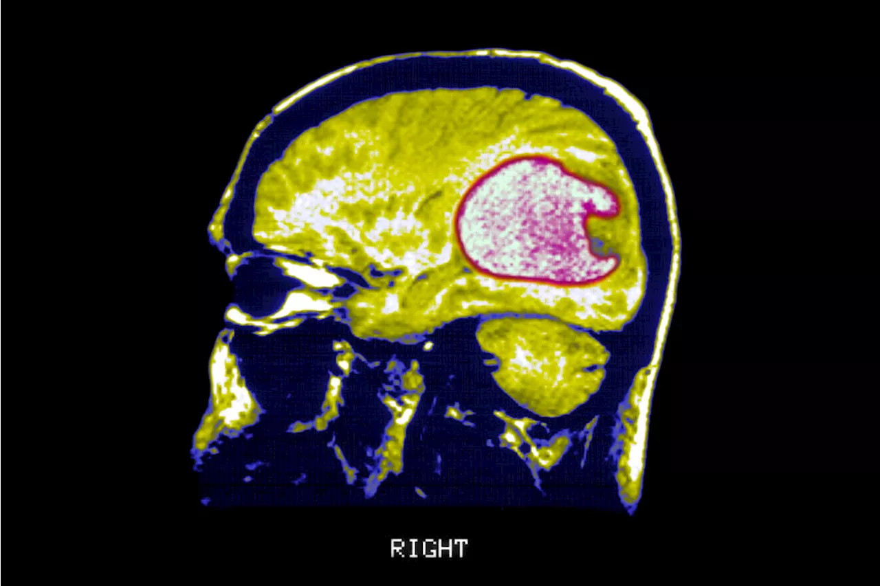 Modified CAR-T therapy shows promise in early clinical trials