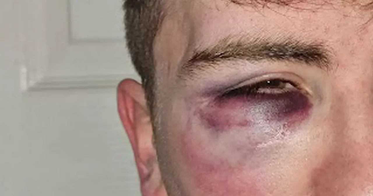 Assault victim says lack of CCTV 'appalling' as police fail to identify attacker