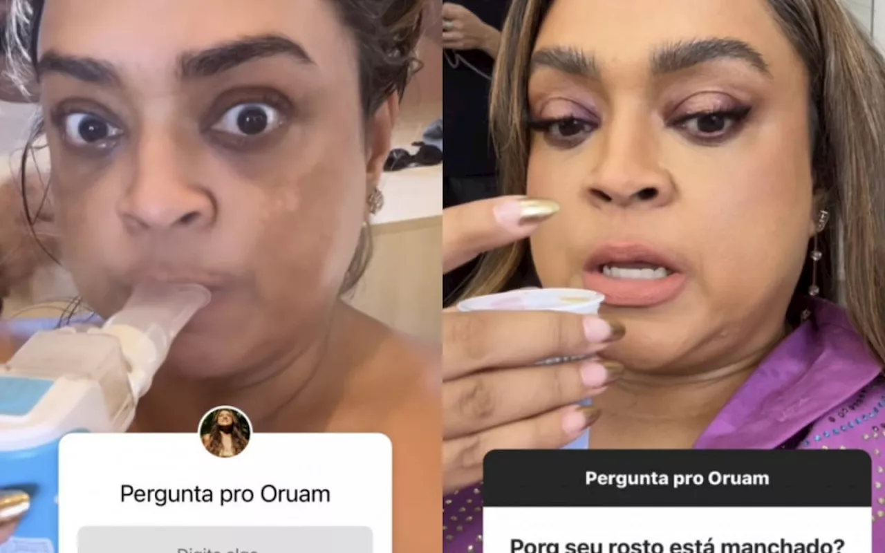 Preta Gil fala sobre melasma no rosto: 'Piorou muito depois da quimioterapia'