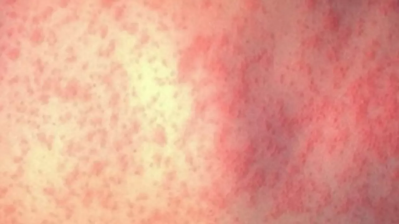 CDC urges vaccination amid rise in measles cases in the US and globally