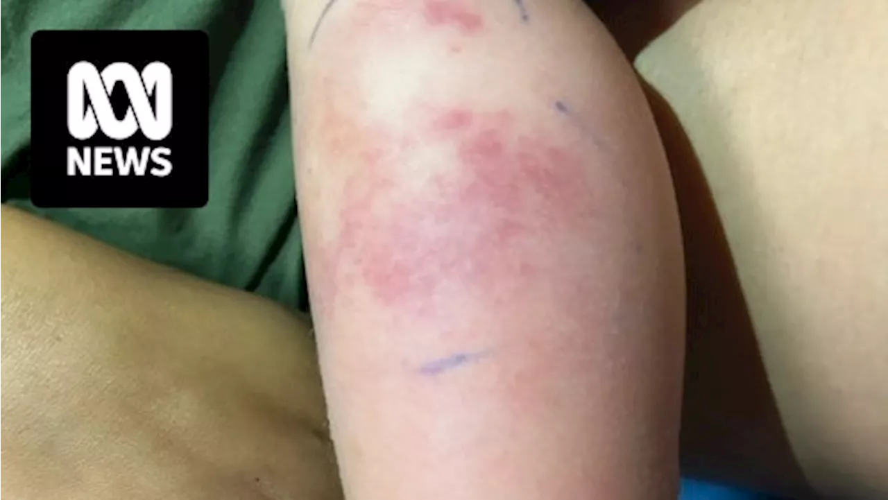 Child suffers severe allergic reaction after being fed dairy at Margaret River daycare