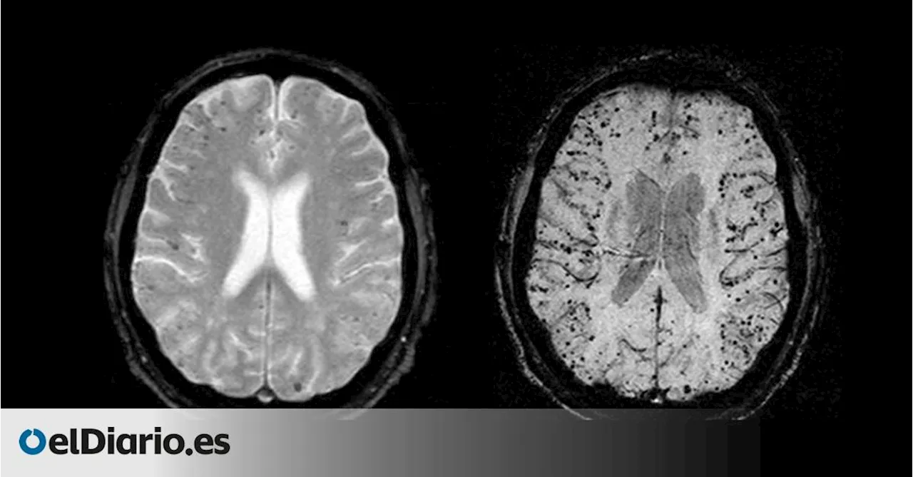 Identifican los primeros posibles casos de transmisión de una enfermedad cerebral en España