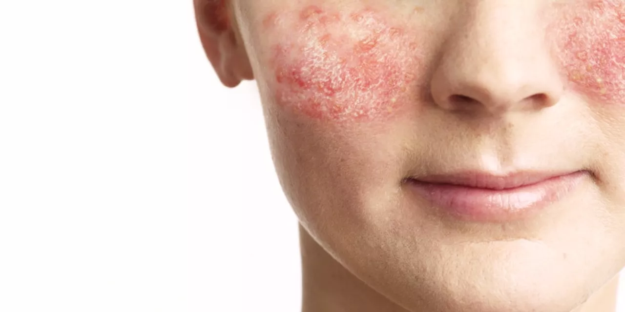 Rosacea : Alles was Sie über Ursachen, Behandlung und Pflege wissen müssen