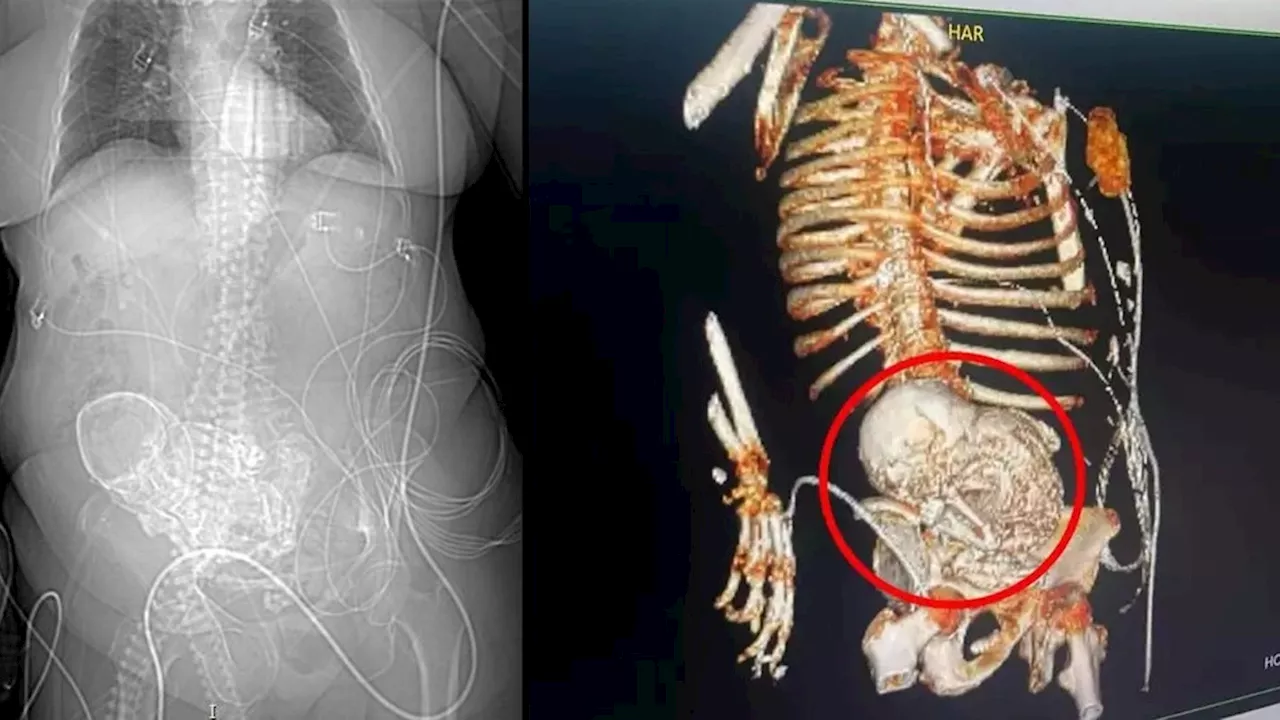 Litopedia: entenda condição rara que calcifica o feto dentro do corpo da mãe