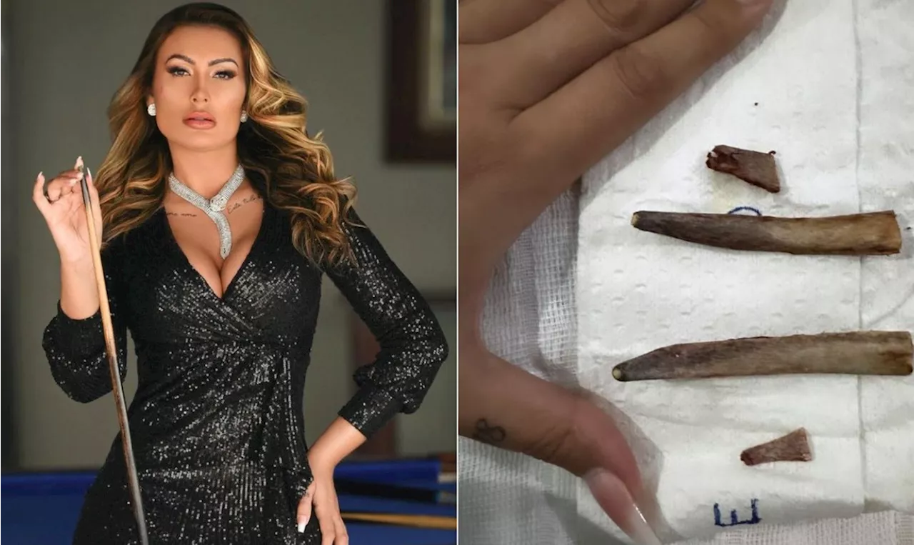 Remoção das costelas: quais são os riscos da cirurgia feita por Andressa Urach