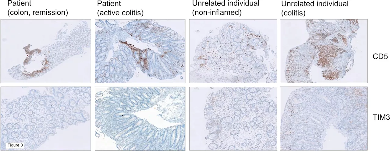 Examining inflammatory bowel disease after a stem cell transplant