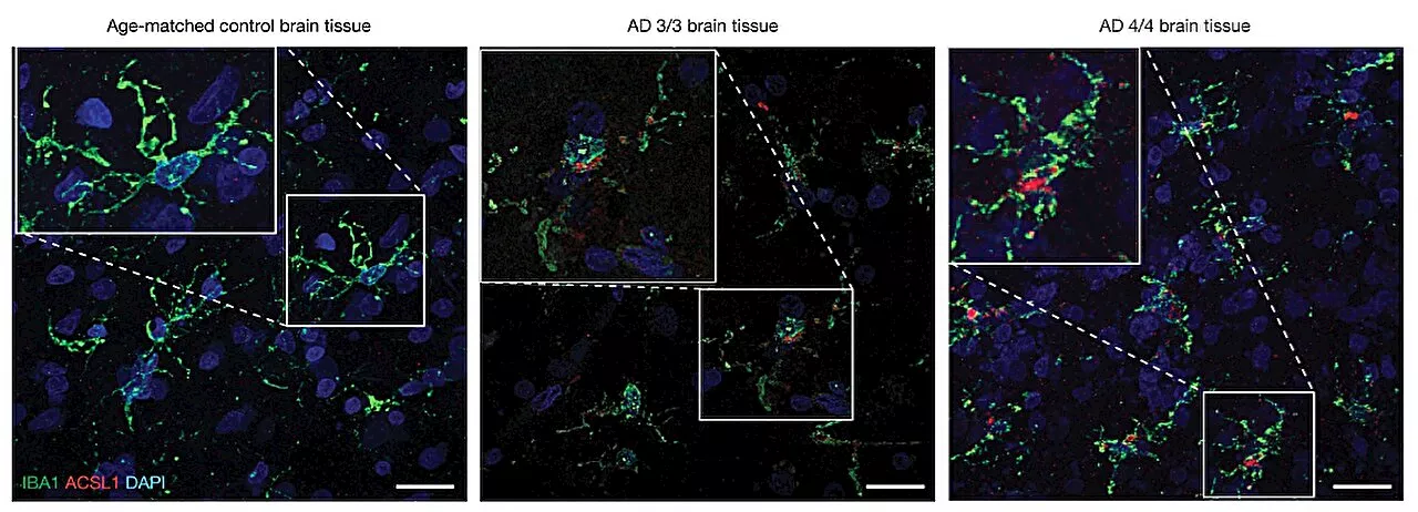 Root cause of Alzheimer's may be fat buildup in brain cells, research suggests